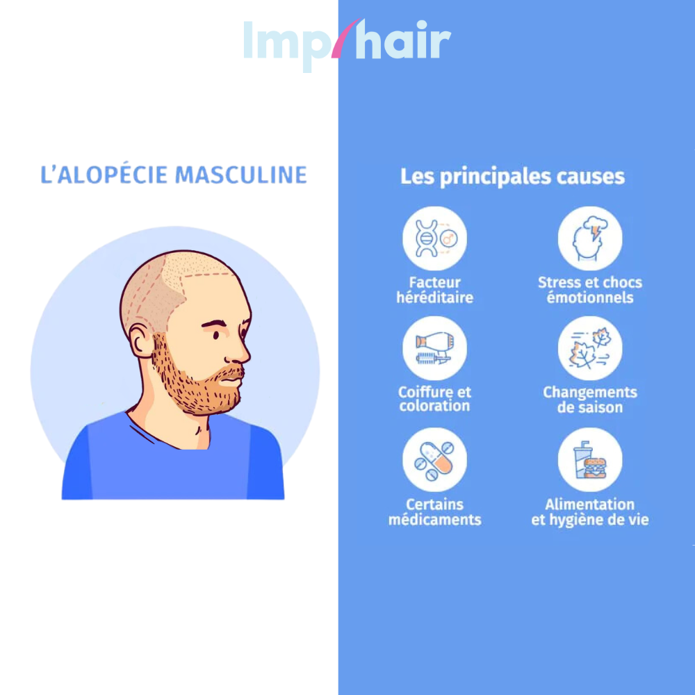 Causes de l'Alopécie chez l'Homme : génétique, stress, nutrition, maladies, médicament.