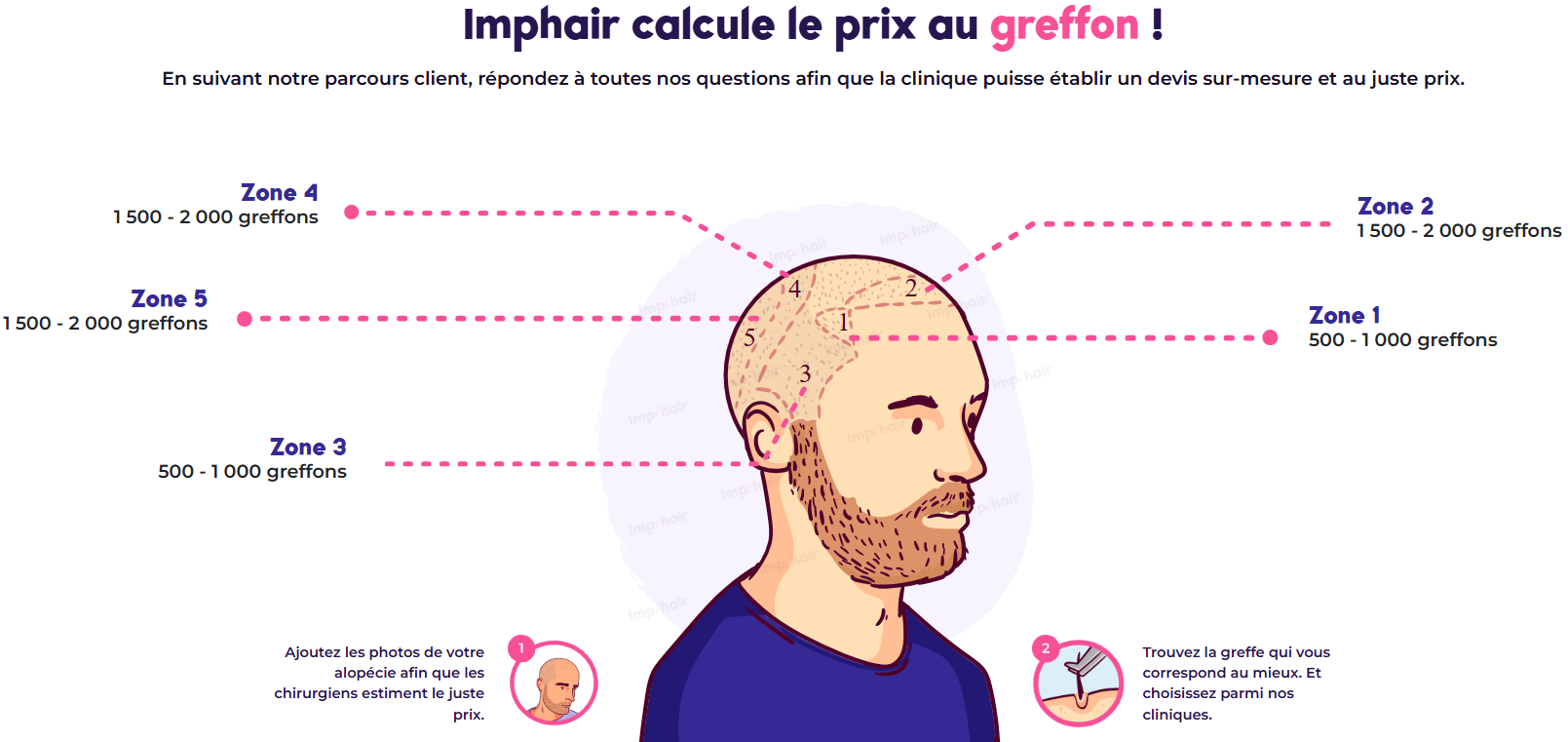 Échelle de Norwood - Nombre de greffons selon la zone