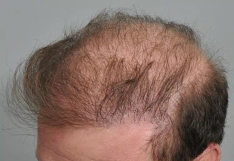 Greffe de cheveux ratée - Absence de repousse après plusieurs mois