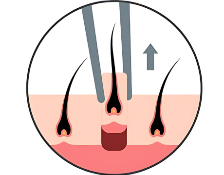 Illustration du processus de greffe FUE avec extraction un par un des follicules pileux.