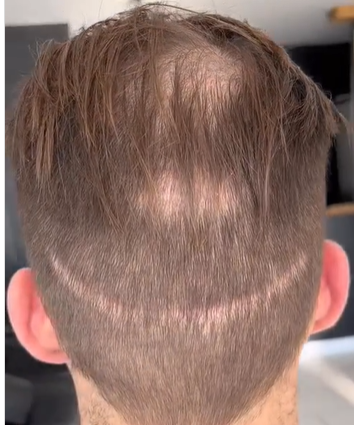 Greffe de cheveux ratée - Cicatrice FUE