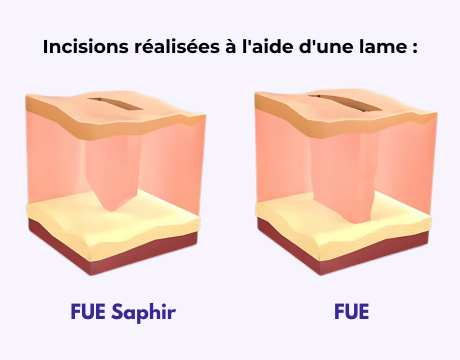 Différence entre une incision classique et une incision avec une lame en saphir pour une greffe FUE Saphir.