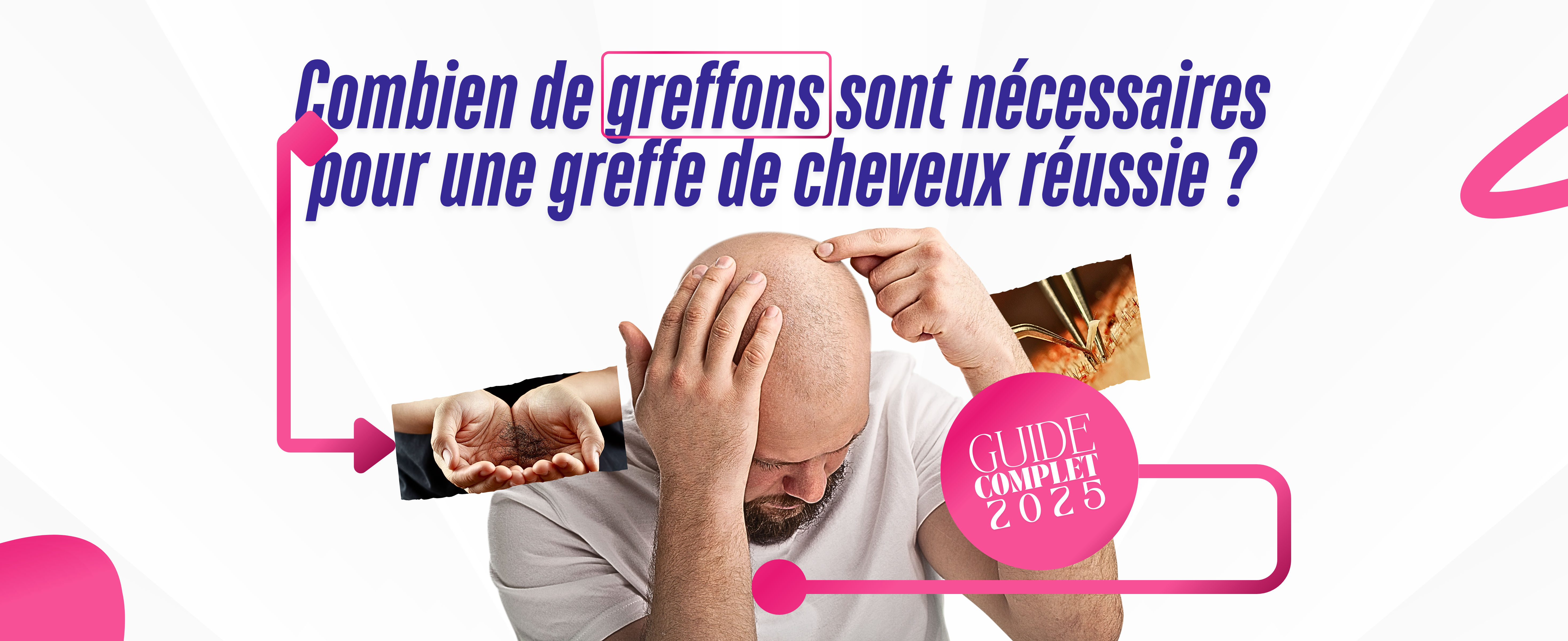 Combien de greffons sont nécessaires pour une greffe de cheveux réussie ? Guide complet 2025