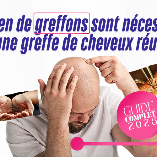 Combien de greffons sont nécessaires pour une greffe de cheveux réussie ? Guide complet 2025